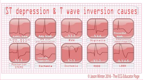 t wave inversion on ekg.